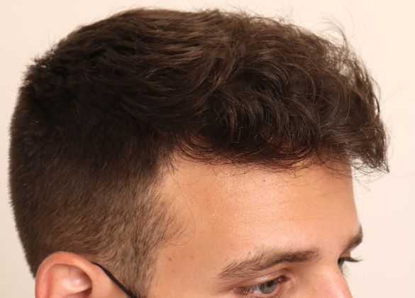 Male Before And After Hair Transplant Photos Cases