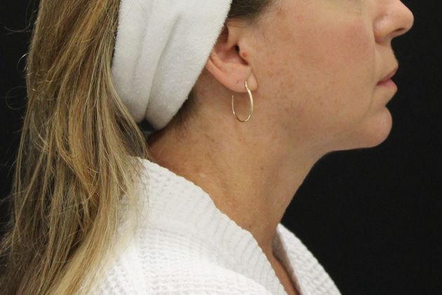 Face & Neck Lifts: Case 14 - After