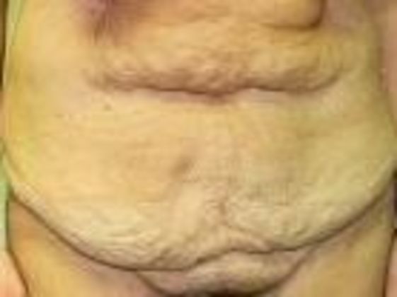 Tummy Tuck Case 2 - Before