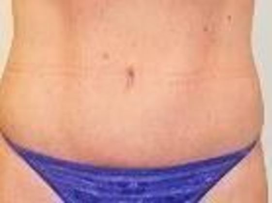Tummy Tuck Case 2 - After