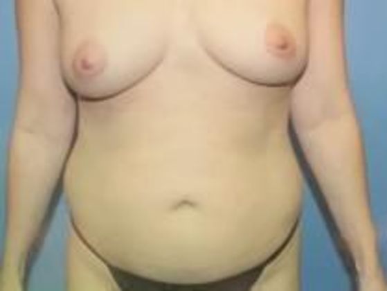 Tummy Tuck: Case 4 - Before