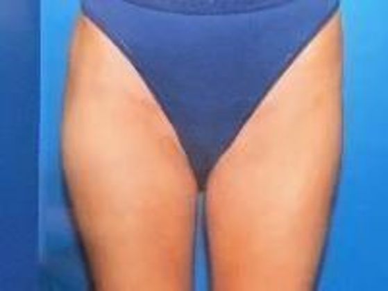 Liposuction Case 2 - After