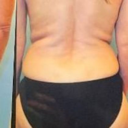 Liposuction Case 3 - Before