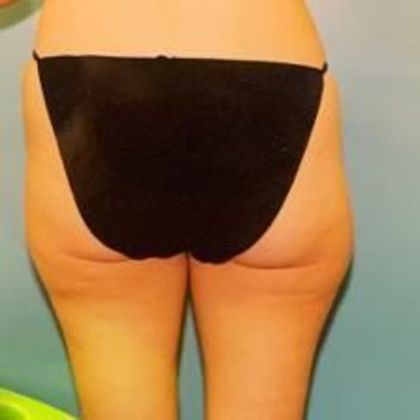 Brazilian Butt Lift Case 1 - Before