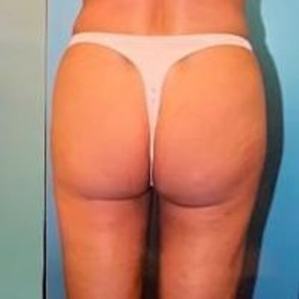 Brazilian Butt Lift Case 1 - After