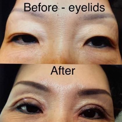 Blepharoplasty: Case 1 - Before