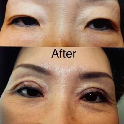 Blepharoplasty: Case 1 - After