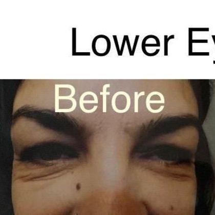 Blepharoplasty Case 2 - Before