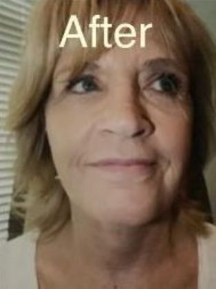 Facelift: Case 2 - After