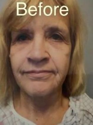 Facelift: Case 2 - Before