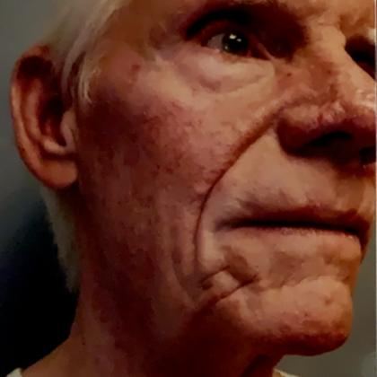 Facelift Case 3 - Before