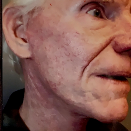 Facelift Case 3 - After