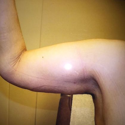 Brachioplasty Case 1 - After