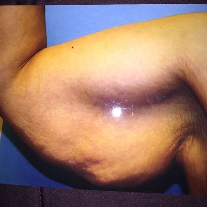 Brachioplasty Case 1 - Before