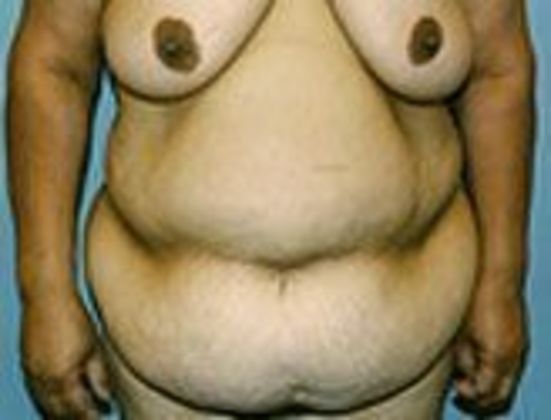 Abdominoplasty: Case 1 - Before