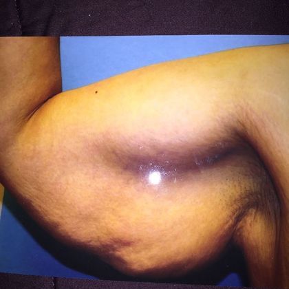 Arm Lift Case 1 - Before