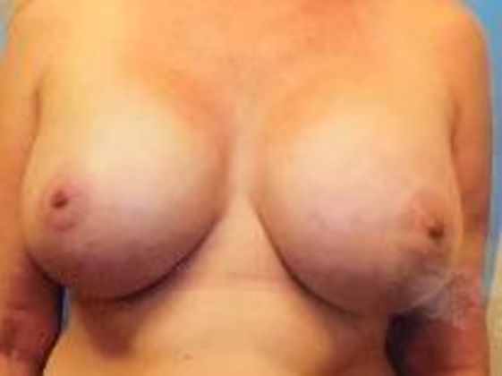 Breast Augmentation Case 5 - After