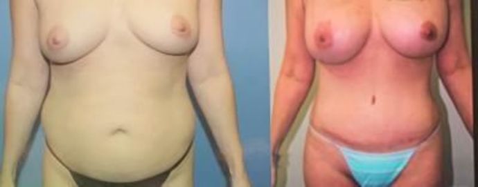 Breast Augmentation: Case 6 - After