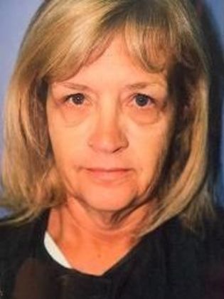 Facelift Case 4 - Before