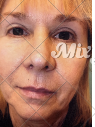 Facelift Case 5 - Before
