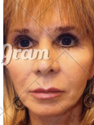 Facelift Case 5 - After