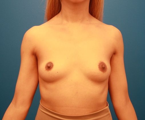 Breast Augmentation Case 2 - Before
