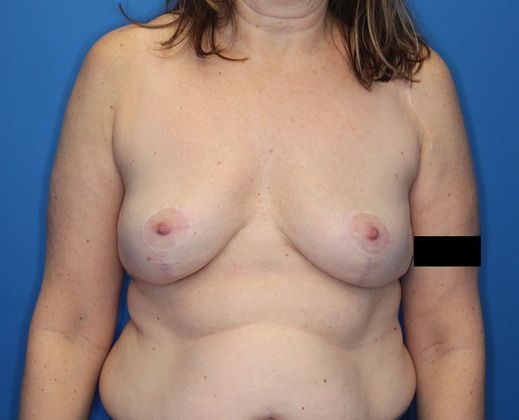 Breast Lift Case 1 - After