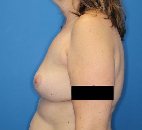 Breast Lift: Case 1 - After