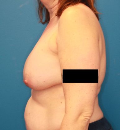 Breast Lift: Case 1 - Before