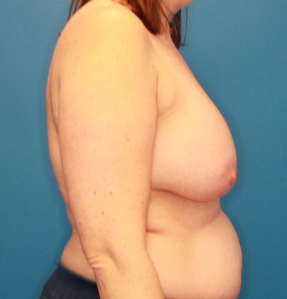 Breast Lift: Case 1 - Before