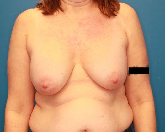 Breast Lift Case 1 - Before