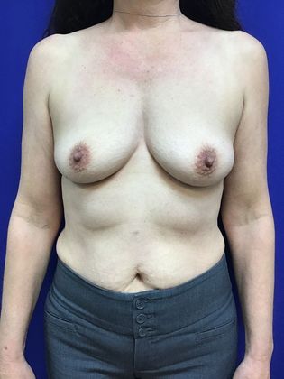 Breast Augmentation  Case 78 (22980) - Before