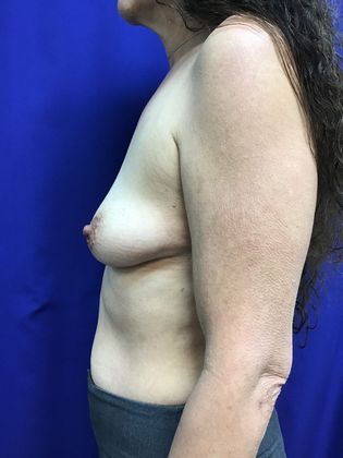 Breast Augmentation : Case 78 (22980) - Before
