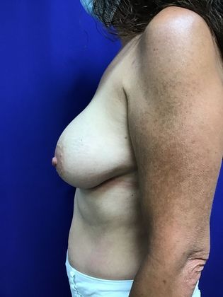 Breast Augmentation : Case 78 (22980) - After