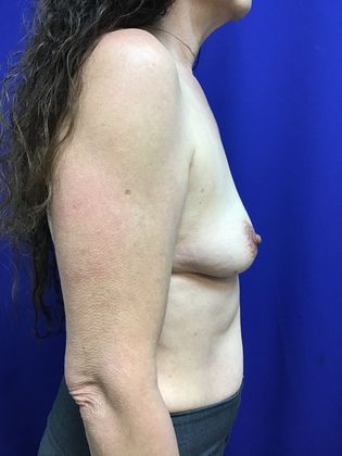 Breast Augmentation : Case 78 (22980) - Before