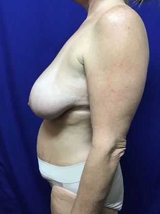 Breast Lift / Mastopexy: Case 36 (22789) - After