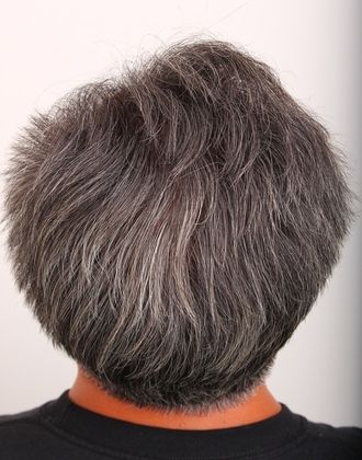 Male Before and After Crown Hair Restoration Photos Cases
