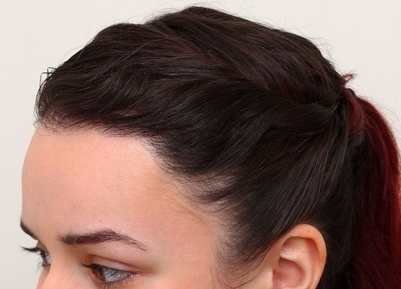 Female Before And After Hair Transplant Photos Cases