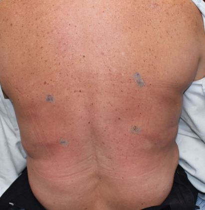 Liposuction Case 6 - After