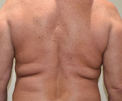 Liposuction Case 6 - Before