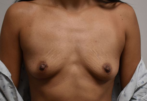 Breast Augmentation w/ Lift: Case 339 - Before