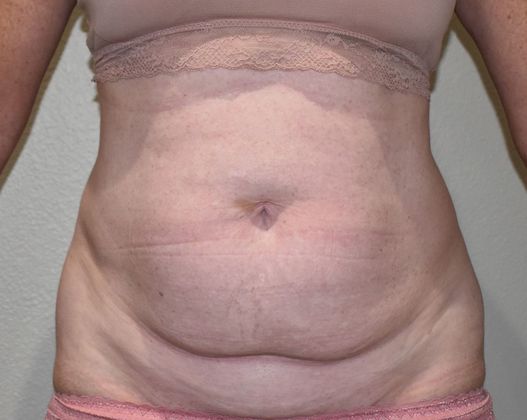 Tummy Tuck (Abdominoplasty): Case 257 - Before
