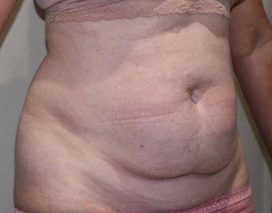 Tummy Tuck (Abdominoplasty): Case 257 - Before