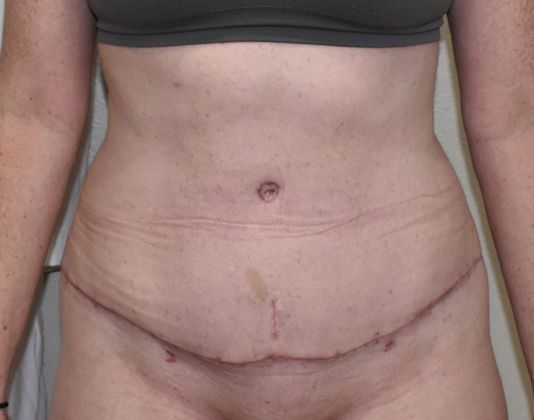 Tummy Tuck (Abdominoplasty): Case 257 - After