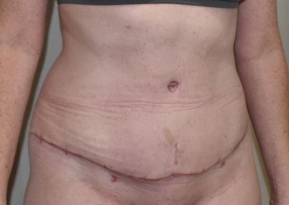 Tummy Tuck (Abdominoplasty): Case 257 - After