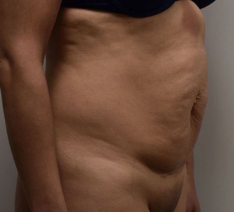 Tummy Tuck (Abdominoplasty): Case 258 - Before
