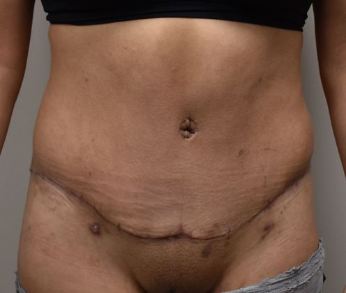 Tummy Tuck (Abdominoplasty): Case 258 - After