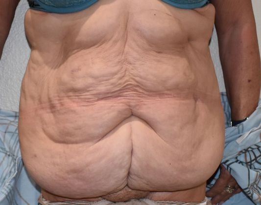 Massive Weight Loss : Case 77 - Before