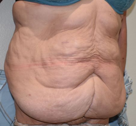 Massive Weight Loss : Case 77 - Before