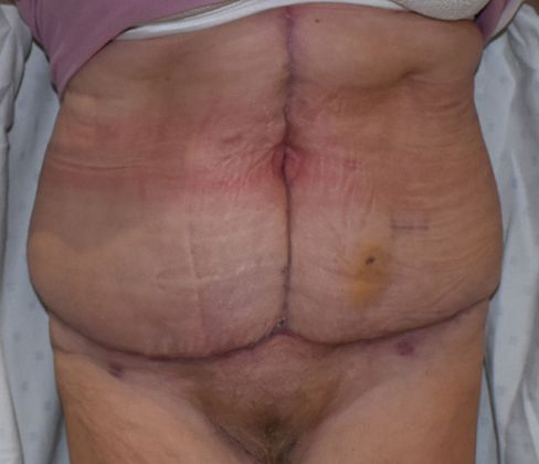Massive Weight Loss : Case 77 - After